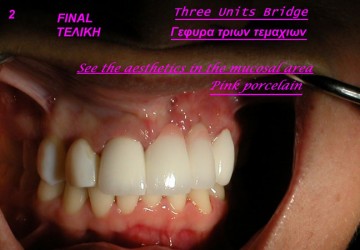 Προσθετική δοντιών