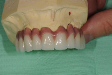 Γενική οδοντιατρική εμφυτεύματα