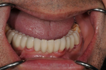 Γενική οδοντιατρική εμφυτεύματα