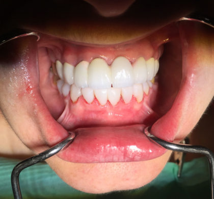 Ολική Αποκατάσταση Στόματος με θήκες μέταλλο πορσελάνης