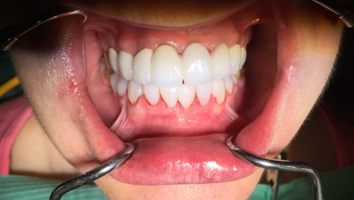 Ολική Αποκατάσταση Στόματος με θήκες μέταλλο πορσελάνης